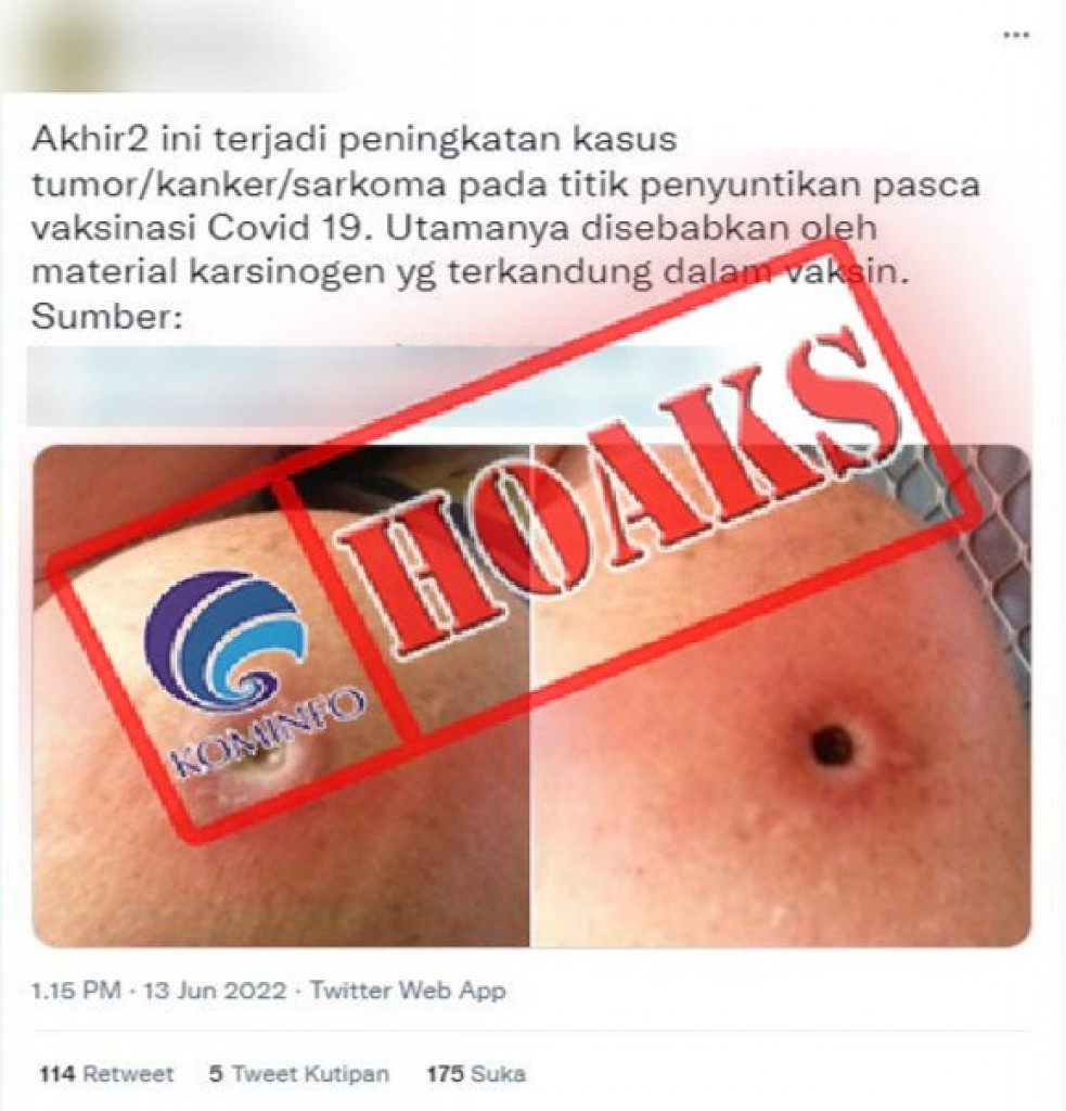 [HOAKS] Vaksin Covid-19 Menyebabkan Peningkatan Kasus Tumor, Kanker, dan Sarkoma