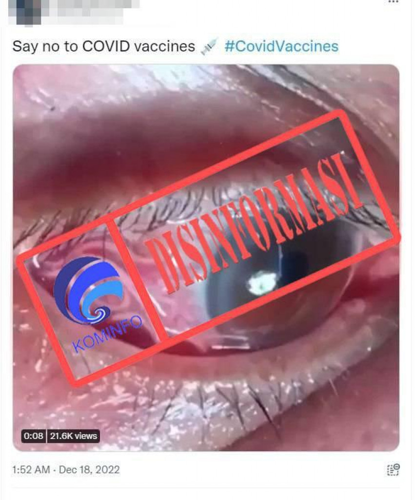 [DISINFORMASI] Vaksin Covid-19 Menyebabkan Infeksi Cacing Parasit pada Bola Mata