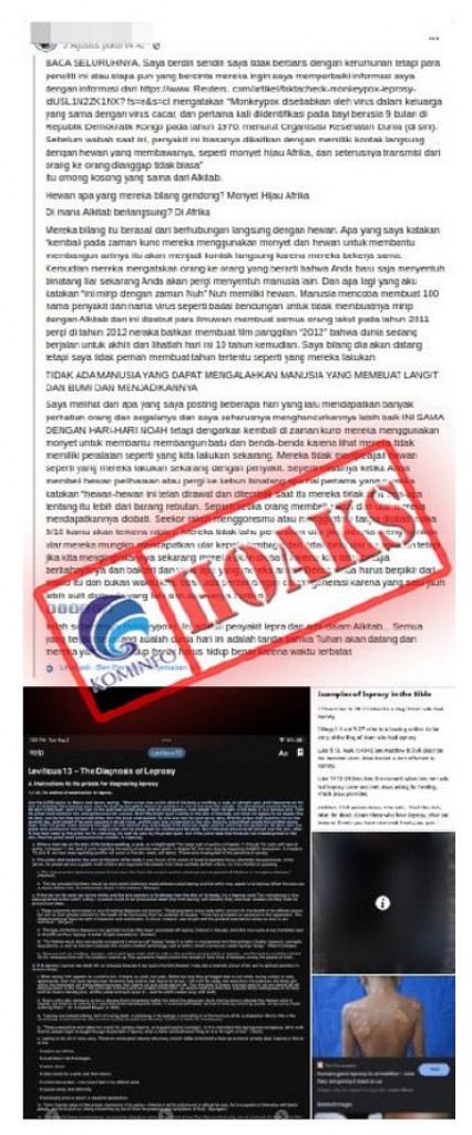 [HOAKS] Penyakit Cacar Monyet Sama dengan Penyakit Kusta